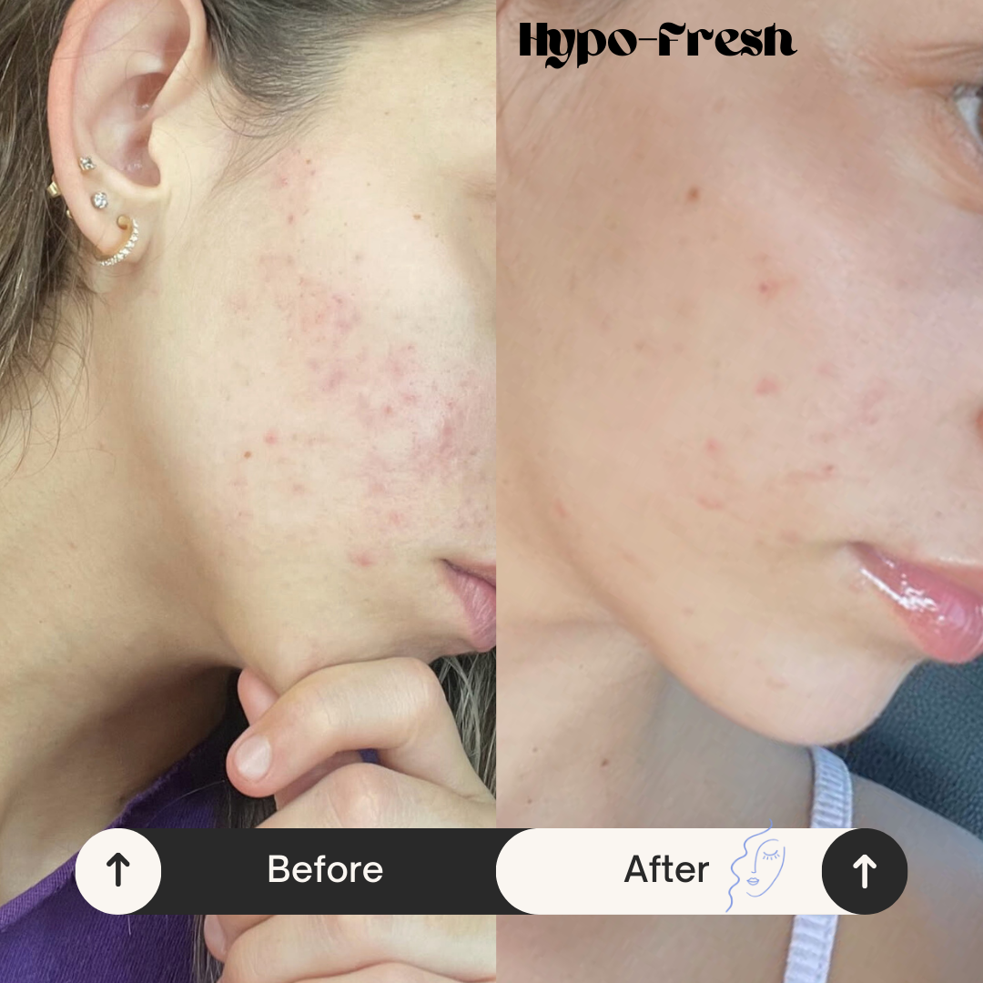 Hypo-Fresh Topical Skin Spray